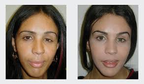 Transgender Surgery Procedure London ...