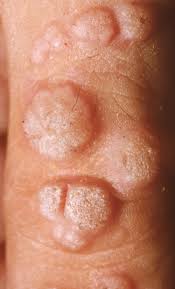 Image result for verrucae filiformes