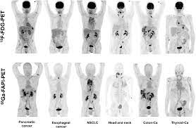 FAP: The Next Billion Dollar Nuclear Theranostics Target? | Journal of  Nuclear Medicine