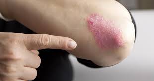 Image result for Seborrheic Dermatitis