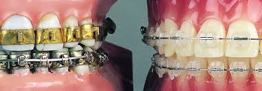 In this video i remove my braces. Pass The Wine Metal Mouth The Whole Tooth About Wearing Adult Braces Cnet