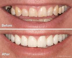 Smile Makeover
