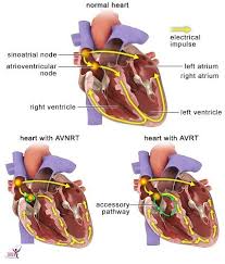 It was formed in 1980 after splitting from sveriges radio, which was responsible for both radio and tv until then. Supraventricular Tachycardia Svt Treatment Dr Sean Gomes