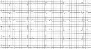 Image result for Early Repolarization
