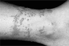 Image result for Rhus Dermatitis