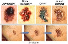 According to current studies, more than eight million americans (and 125 million people worldwide) have psoriasis. Pin On Skin Moles