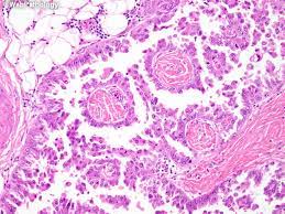 This is the newest place to search, delivering top results from across the web. Webpathology Com A Collection Of Surgical Pathology Images