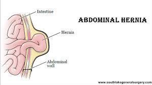 Image result for stomach hernia symptoms