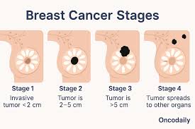 Image result for Breast Cancer