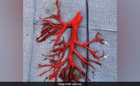 Clotting is normal, but clots can be dangerous when they do not dissolve. Covid Not Just Lung Disease Can Also Cause Lethal Blood Clots Experts