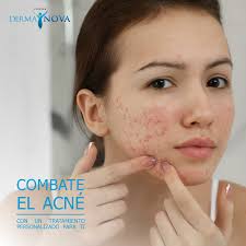 𝗖𝗢𝗠𝗕𝗔𝗧𝗘 𝗘𝗟 𝗔𝗖𝗡É 👉El acné es una enfermedad cutánea frecuente,  que produce granos y otras anomalías en la piel. Reserva una cita con  nosotros y recibe un tratamiento personalizado según la causa