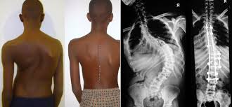 A 14yr Old Boy With Scoliosis Treated Successfully At Miot Healthzine Miot International