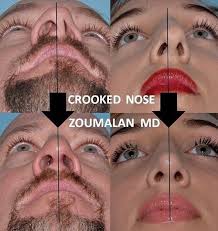 Pin By Sammie On Nose Jobs Nose Job Crooked Nose Nose