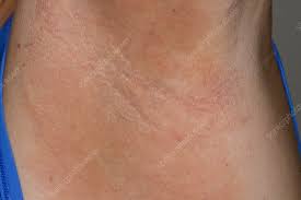 Image result for Erythrasma