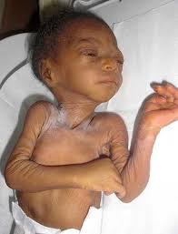 Effects of Malnutrition in Haiti
