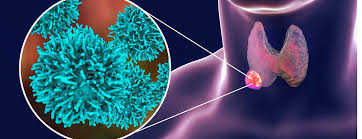 Malignant (cancerous) thyroid goitres or nodules are rare (as little as 5% of cases) and may take several years to develop. Thyroid Nodules Johns Hopkins Medicine