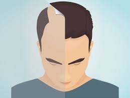 Male pattern hair loss is a form of hair loss that typically appears at the front, midscalp before hair loss sets in, the growing phase lasts up to six or seven years, while the resting phase lasts about 100 days. Male Hair Transplant Uk Cost And Things To Consider British Gq British Gq