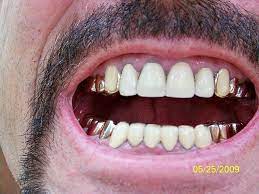 Gold crowns have two main disadvantages: Gold Teeth And Crowns Front View Tips For Obtaining Free Silver And Beat The Declining Dollar Gold Teeth Men Gold Teeth Grillz Teeth