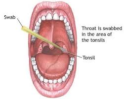 Both patients and their doctors easily overlook the first signs and symptoms of throat cancer. Throat Cancer 1st Stage Symptoms Celine Dion Songs Age