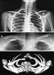 Image result for SC Dislocation