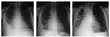 Image result for Pleural Tuberculosis