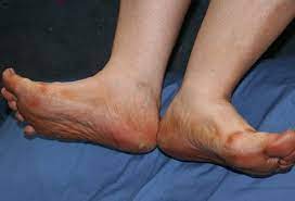 Symptoms of type 1 diabetes can start quickly, in a matter of weeks. How Diabetes Can Affect Your Feet