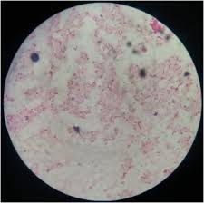 Ornithinolytica has the ability to convert histidine to histamine in scombroid fish. Clinical Manifestation And Outcomes Of Multi Drug Resistant Mdr Raoultella Terrigena Infection A Case Series At Indus Health Network Karachi Pakistan Sciencedirect