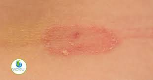 So, does hand sanitizer really kill coronavirus? Can Hand Sanitizer Kill Ringworm