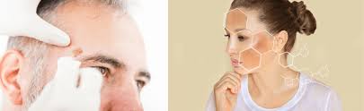 Fadenlifting & vampirlifting facelift ohne skalpell; Altersflecken Pigmentflecken Entfernen In Munchen Hautok