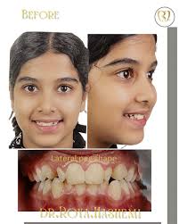 Non Extraction orthodontic for a 13-year-old girl with moderate crowding  and lateral peg-shape teeth. ارتودنسي بدون كشيدن دندان براي دختر ١٣ ساله با  دندانهاي لترال برنجي شكل كه در بزرگسالي نيازمند