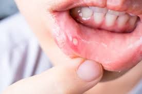 Image result for mouth ulcer on tongue)