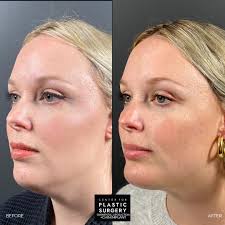Small change, big impact! ✨ A chin implant can bring beautiful balance to  the face and completely transform a guest's profile. By enhancing the  chin's projection, this procedure helps create better facial