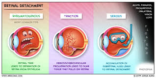 Retinal Detachment Detachment Practical Nursing Medical Surgical Nursing