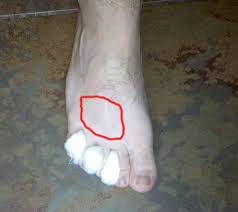 It is an overuse injury which is common in runners, especially if your shoes do not fit properly, or are laced too tight. Pin On Running