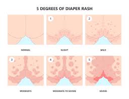 Image result for diaper dermatitis