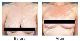 We did not find results for: Why Breast Reduction In Louisville Ky Caloaesthetics Plastic Surgery