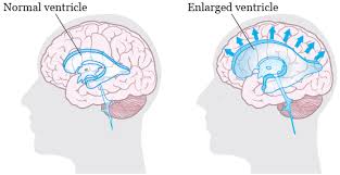 About Your Ventriculoperitoneal Vp Shunt Surgery Memorial Sloan Kettering Cancer Center