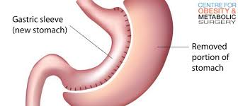 Best Obesity Surgeon Delhi We Believe That Everybody Deserves A Second Chance And We Would Be Sleeve Gastrectomy Sleeve Surgery Vertical Sleeve Gastrectomy