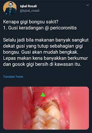 Join facebook to connect with bongsu gigi and others you may know. Kenapa Gigi Bongsu Sakit Di Unit Pusat Sejahtera Usm Facebook