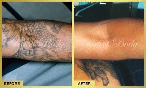 Don't worry about making an appointment; Tattoo Removal Gallery Perfect Body Laser Aesthetics Long Island Ny