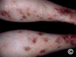 Image result for Panniculitis