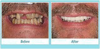 The team at a better smile believes that everyone deserves a healthy, more confident smile. Dental Implant Procedure Overview For A Better Smile