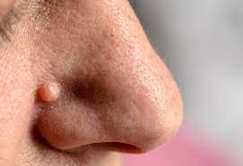 Die stachelwarze , die auch vulgäre warze genannt wird, tritt zumeist bei kindern oder jugendlichen auf. Was Sind Warzen Und Wie Entstehen Sie