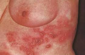 Marburg virus is a hemorrhagic fever virus of the filoviridae family of viruses and a member of the species marburg marburgvirus, genus marburgvirus.marburg virus (marv) causes marburg virus disease in humans and nonhuman primates, a form of viral hemorrhagic fever. Infektionskrankheiten Springerlink