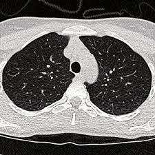 Im ekg können veränderungen im kurvenbild oder herzrhythmusstörungen eine herzmuskelentzündung wird als myokarditis bezeichnet. Klinik Und Poliklinik Fur Radiologie Herz Thorax