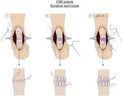 The number of loops versus the number of sutures. Interlocking Horizontal Mattress Suture Versus Kakiuchi Technique In Repair Of Achilles Tendon Rupture A Biomechanical Study Journal Of Orthopaedics And Traumatology Full Text