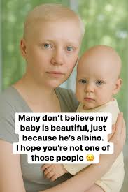 Of course, I am a person with Albinism. I see the world in a unique way,  with a heart full of love and a spirit that shines bright. My albinism is a