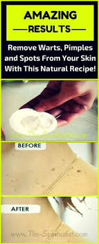 Amazing Home Remedy To Destroy Moles Warts Blackheads And Age Spots 16 Recommended Skin Care Routi Recommended Skin Care Routine Warts Skin Care Blackheads
