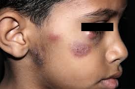 Pediatric Patient: Case Report....