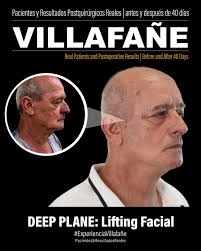 Sabías que el tiempo no tiene que dictar cómo te ves ni cómo te sientes?  Con la técnica Deep Plane Lifting, devolvemos firmeza, armonía y juventud a  tu rostro, logrando resultados naturales